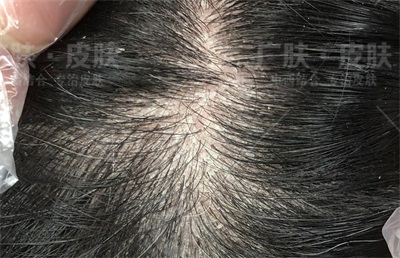 10.8脂溢性皮炎-广肤_看图王