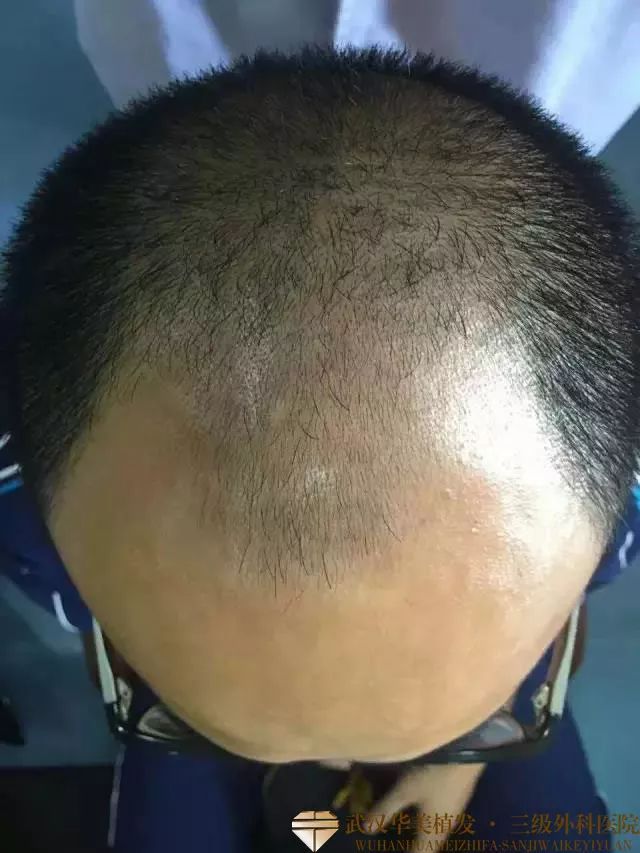 厦门治疗男性脱发大概要多少钱【厦门广肤皮肤病专科怎么样】