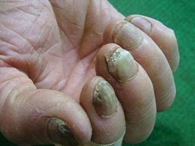 得了灰指甲怎么办【厦门广肤皮肤病医院怎么样】