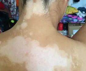 女性白癜风患者在生活中应该注意哪些细节【厦门广肤皮肤病专科怎么样】